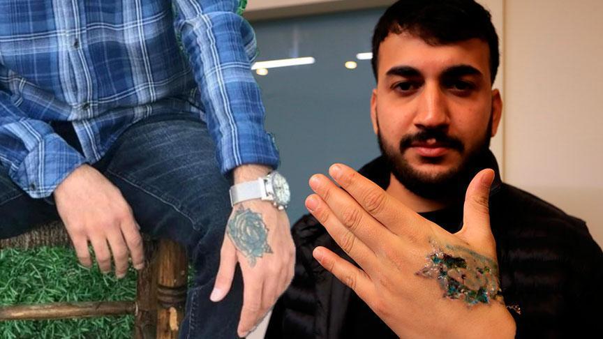 Dövme sildirmek isterken felaketi yaşadı! 'Eczaneden ağrı kesici al'