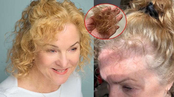 12 kilo verdi ama saçları avuç avuç döküldü! Kökleri küçülten tehlike: 'Etkisi uzun'