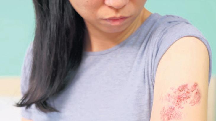 Antioksidanlarla zonaya karşı güçlenin