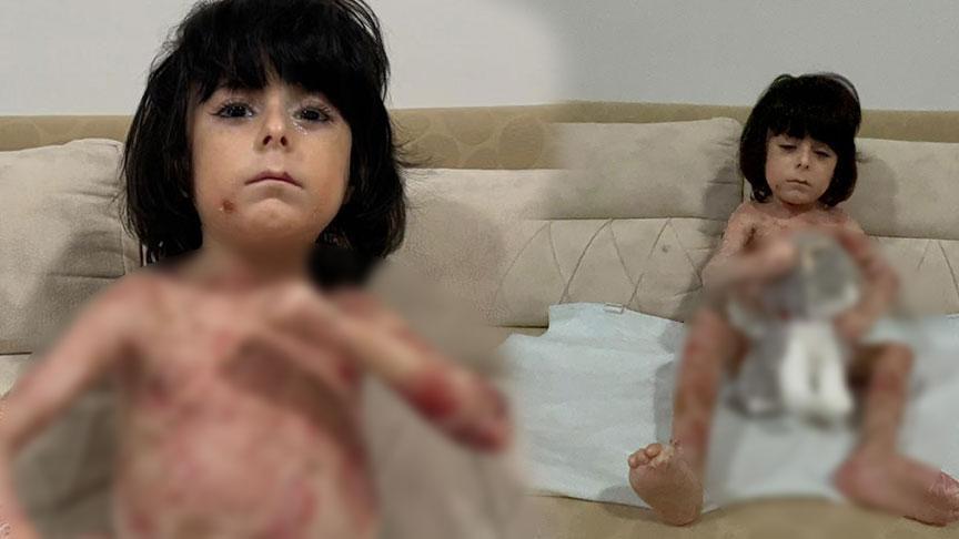 Yaraları tüm vücudunu sardı! 4 yıldır mücadele ediyor: çaresiz durumda