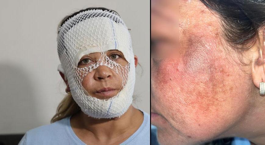 7 bin liralık ‘Prenses cilt bakımı’ kabusu: Oğlum beni görünce 'öcü' diyerek kaçtı