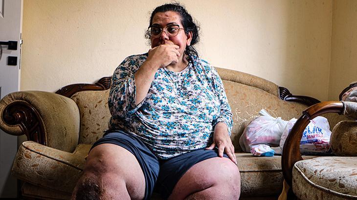 Fil hastası 3 çocuk annesi, tedavi olmak için yardım bekliyor: Yaralarda kurtlanma oluşuyor